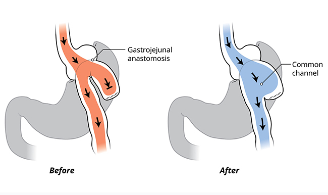 graphic of before with gastrojejunal anastomosis and after with common channel - Endoscopic Procedure Allowing Patient To Eat Again