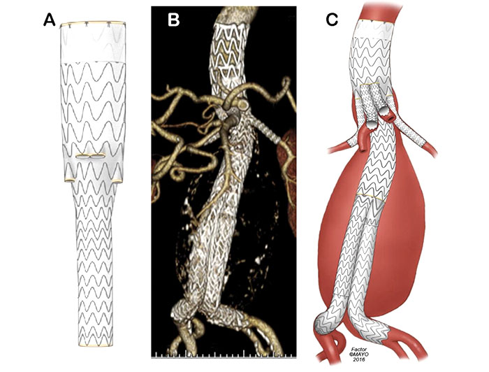 Intermountain Medical Center. Illustration and microscopicscan of aortic valve