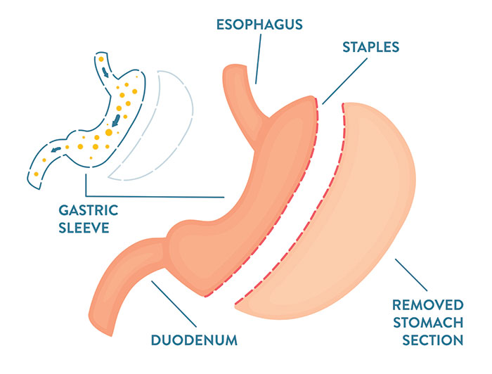 Hackensack Meridian Pascack Valley Medical Center. A diagram of stomach changes with gastric sleeve surgery shows staple placement and removed stomach section