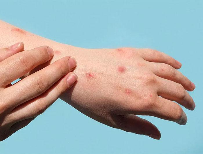 stock image of bite- or sore-covered hand