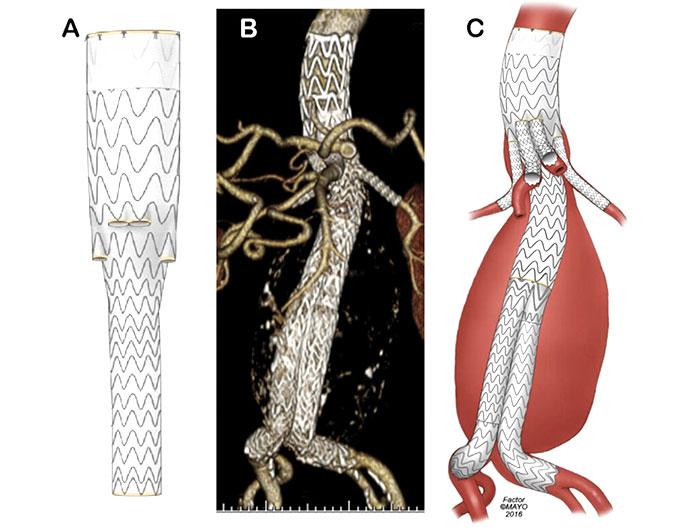 Illustration of aortic valves