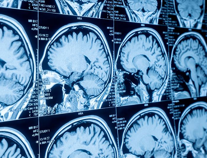 Stock image of a series of brain scans displayed on a viewing board